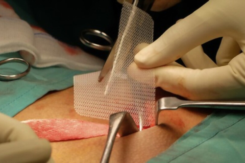 Cirugía de hernias complejas de la pared abdominal