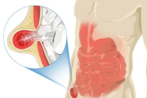 Cirugía de hernia inguinal