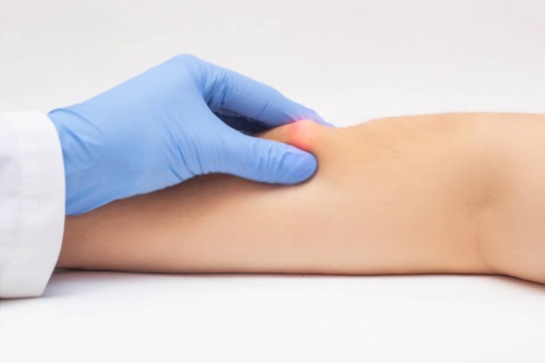 Resección de lipomas