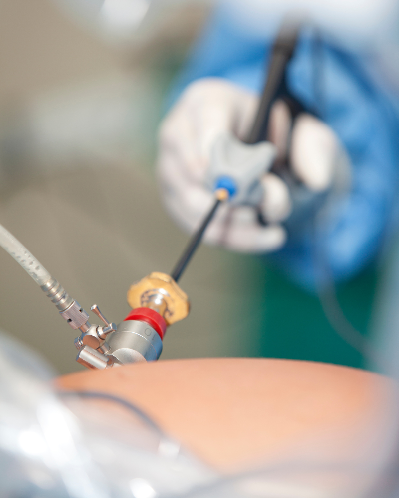 cirugia-laparoscopica-de-vesicula-precio