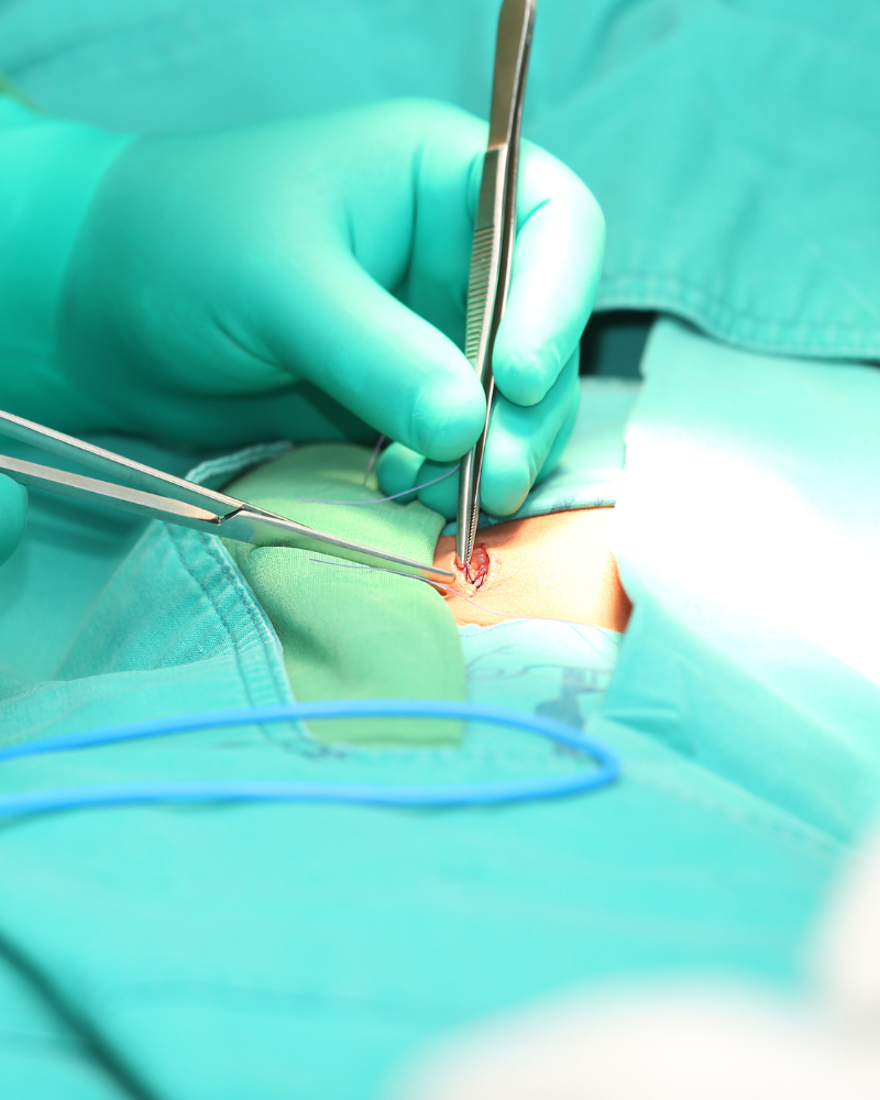 cirujano-de-hernias-en-benito-juarez