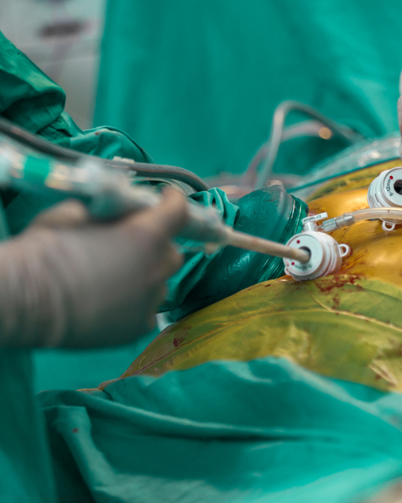 operacion-de-hernia-por-laparoscopia-precio