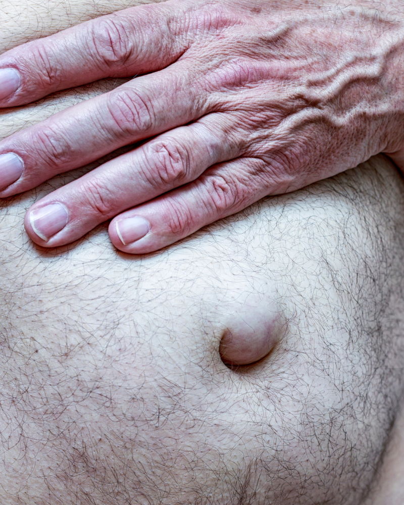 operacion-de-hernia-umbilical-precio